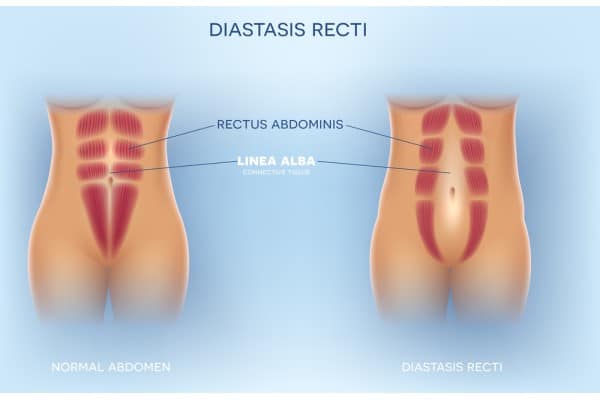 What Non-Surgical Options Are Available for Diastasis Recti Sherborne?