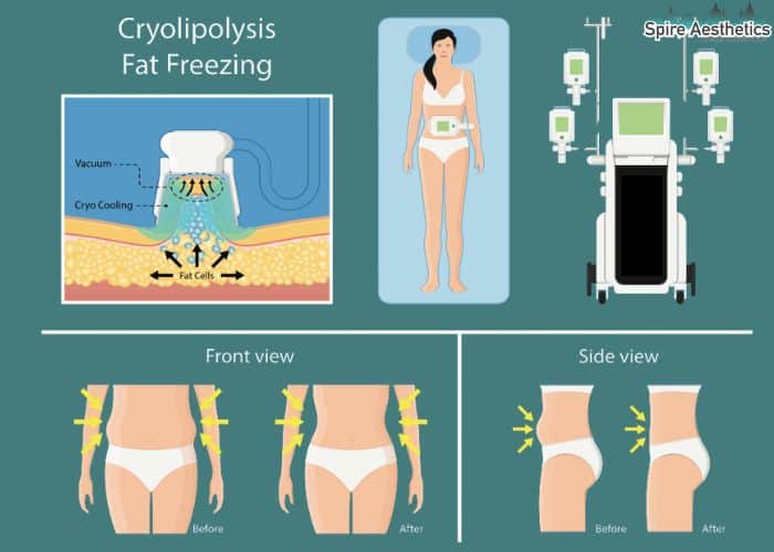 Image of diet and fat freezing combined for best results for Spire Aesthetics Sherborne